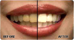 Teeth Whitening Best Dental Clinic Ahmedabad India