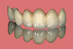 Dental Bridge cost also Metal Free Dental Bridge Cost in Ahmedabad, India