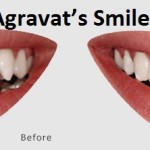 veneers smile makeover by Dr Agravat’s Smile in an Hour before after image