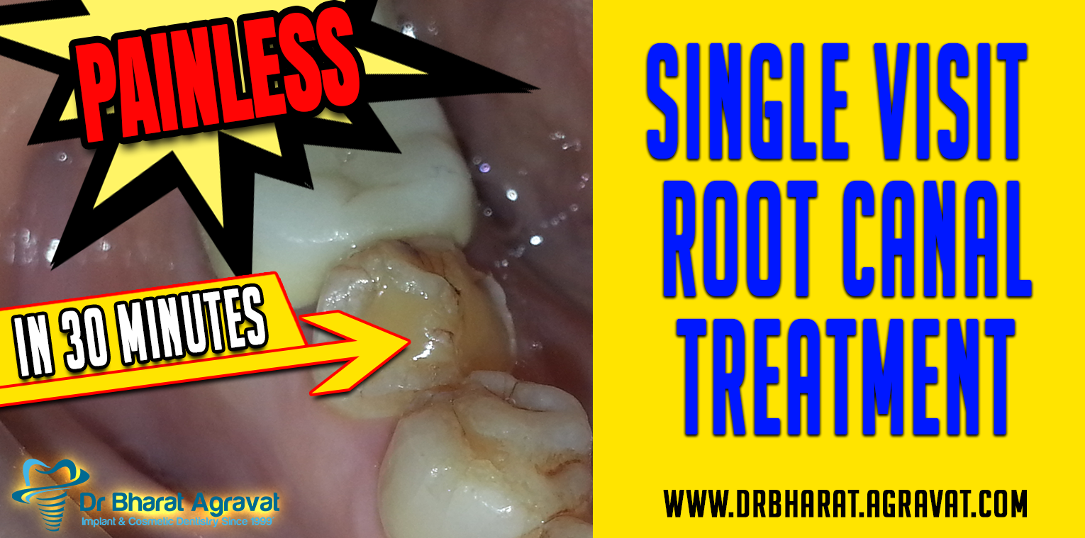Root Canal treatment in 30 min Painless Single Visit Procedure Ahme