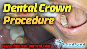 Dental Crown procedure cost in Ahmedabad Gujarat India