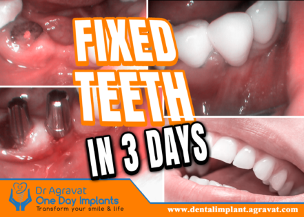 Permanent Fixed teeth in 3 days Ahmedabad India