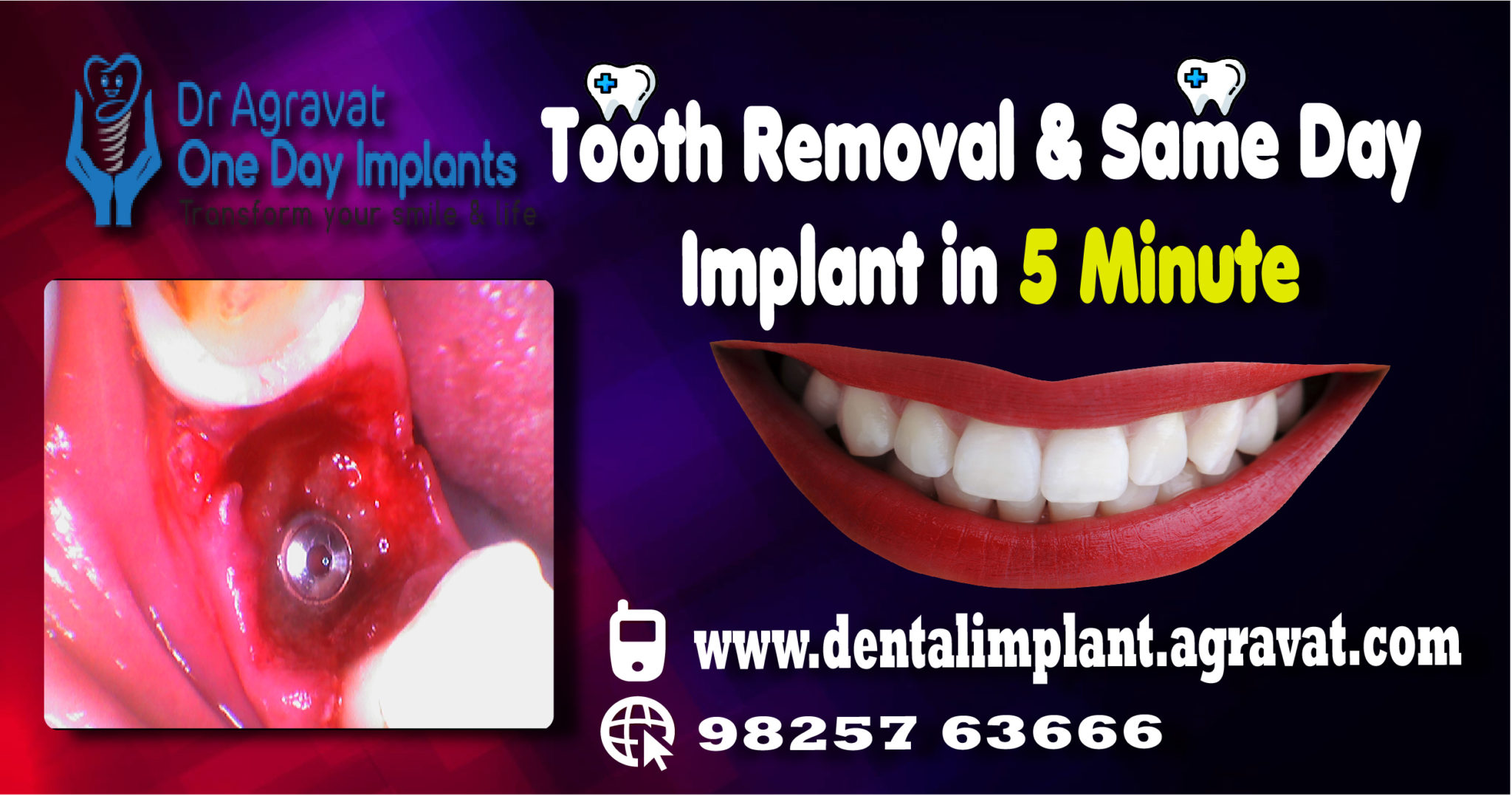 Tooth Removal Same Day Implant Place Surgery procedure VideoFamous best