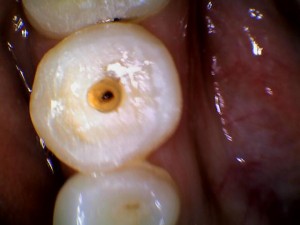 Single Canal in Lower Right Mandibular Premolar by Dr Bharat Agravat