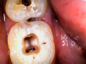 Three Canal in Lower Right Mandibular Molar by Dr Bharat Agravat.