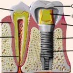 dental implant dr bharat agravat