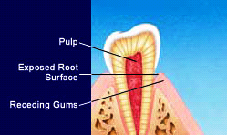 Sensitive Teeth