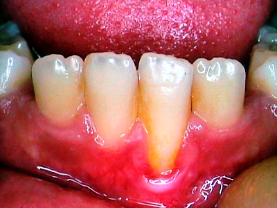 Sensitive Teeth 
