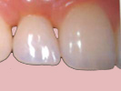 single teeth crown with implant gujarat by dr bharat agravat