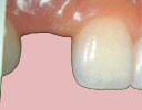 single teeth replace by dr bharat agravat india