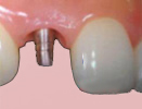 single teeth replace implant ahmedabad by dr bharat agravat