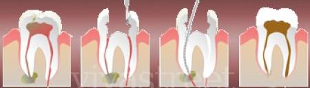 Painless Single Visit Root Canal Procedure Dr Agravat Dental Clinic Ahmedabad,India