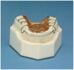 Habit Breakeer Removable appliance Dental clinic ahmedabad