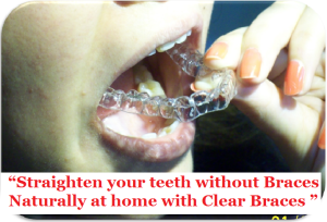 Invisible Braces for Adult Ahmedabad Dr Bharat Agravat India