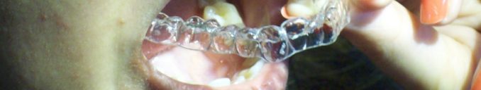 What are Clear Braces? Or Invisible Braces? by Dr Bharat Agravat, Ahmedabad, Gujarat, India