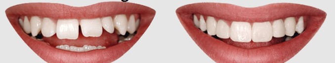 veneers smile makeover by Dr Agravat’s Smile in an Hour before after image