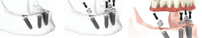 Step by Step All on 4 dental implants Procedure by cosmetic implants dentist bharat agravat ahmedabad india