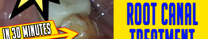 Single Visit Root Canal Treatment in 30 min by dr bharat agravat ahmedabad Gujarat India