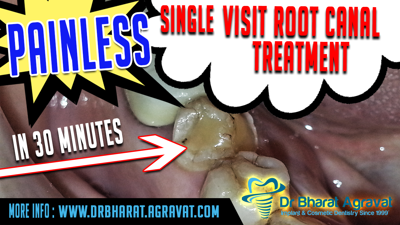 Single Visit Root Canal Treatment in 30 min ahmedabad Gujarat India