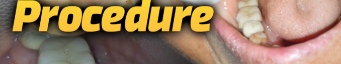 Dental Crown procedure cost in Ahmedabad Gujarat India