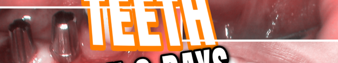 Fixed teeth in 3 days with Basal dental implants Ahmedabad, Gujarat, India Dr Bharat Agravat