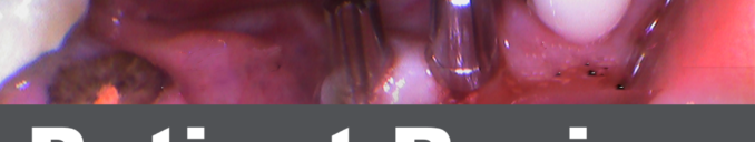 Broken and Missing Teeth Replaced by Same Day Dental Implants supported Bridge and Crown at Dr Agravat One Day implants Clinic Ahmedabad.