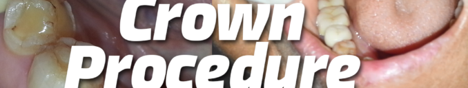 Dental Crown procedure cost for broken, Caries, fracture, after root canal tooth in Ahmedabad, Gujarat, India.