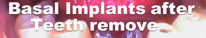 Basal Implants Procedure Cost for Lower Front Mobile Teeth Remove & Replacement | How dental Implants surgery are Done in Ahmedabad, India.