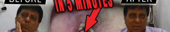 wisdom tooth removal cost in ahmedabad gujarat india