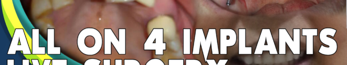 All on 4 Dental Implant Surgery Step by Step Procedure Video Ahmedabad Gujarat India