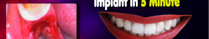 Tooth Removal Same Day Implant in 5 Minute Step by step dental implant surgery in Ahmedabad, Gujarat, India.