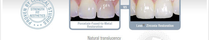 zirconia ceramic dental bridge cost in ahmedabad gujarat india