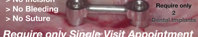 Fix ill fitting loose lower dentures in 90 Minutes Best Implants Dentist Ahmedabad Gujarat India