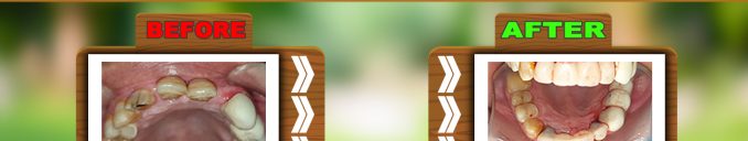 How to Fix Crooked Front Teeth without Braces also Broken or Missing Teeth with Dental Implants in Hour Ahmedabad Gujarat India