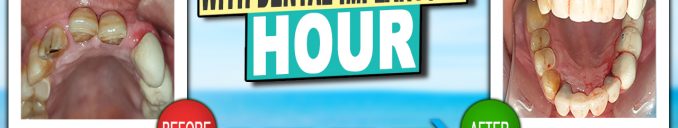 ix anterior front crooked, Broken or Missing Teeth with dental implants in an hour Ahmadabad Gujarat India