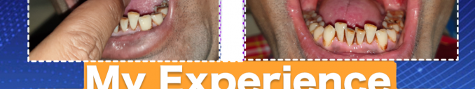 Mouth Opening Treatment laser cost in ahmedabad gujarat india