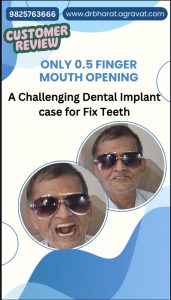 Mr. Shah Reviews Mouth Opening OLI Therapy & Fixed Teeth by Dental Implants – Transformative Experience by Dr. Bharat Agravat